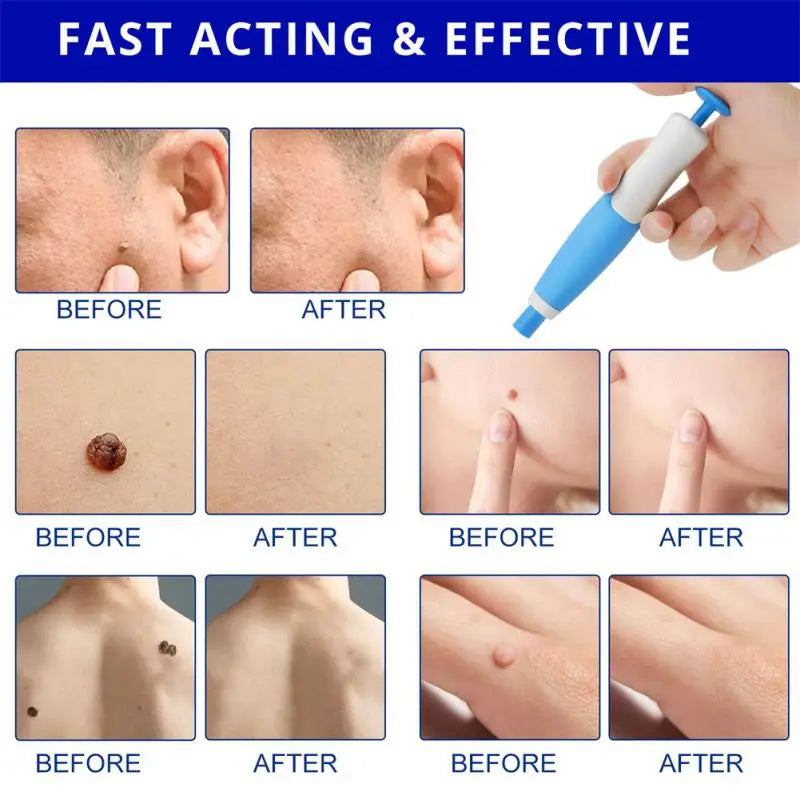 "Double-Head Auto Skin Tag Remover: Painless Mole and Wart Removal Kit with Cleansing Swabs"